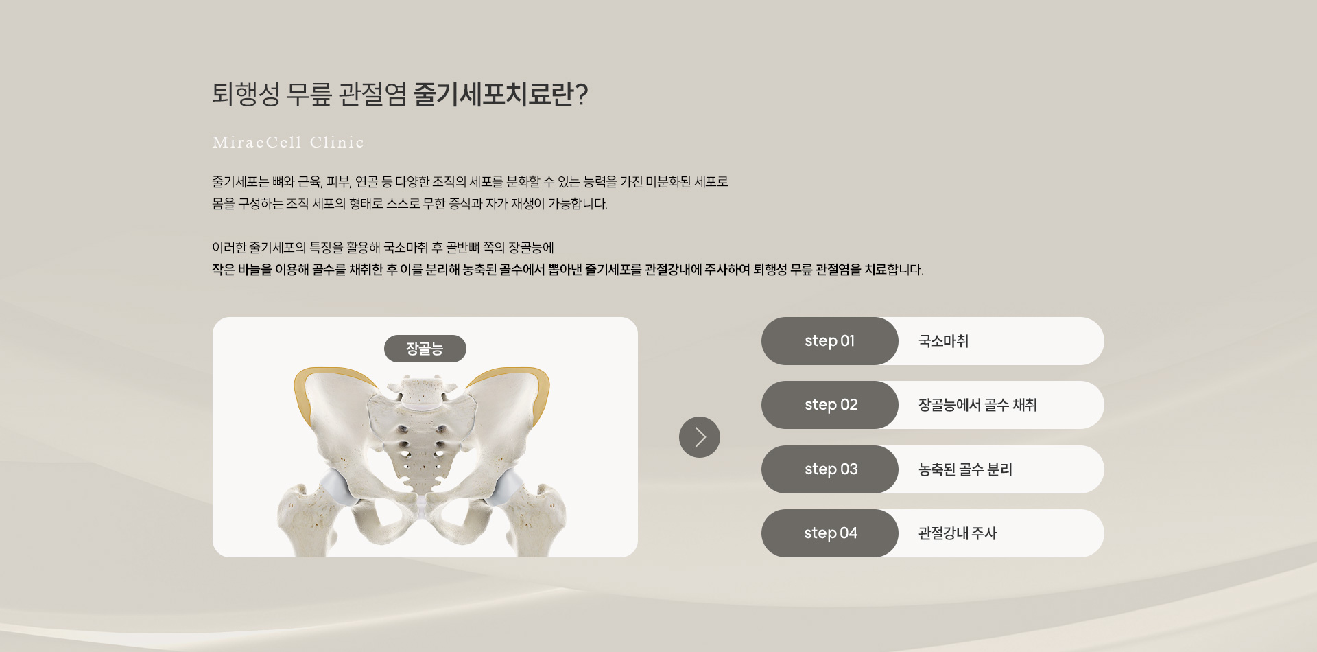 퇴행성 무릎 관절염 줄기세포치료