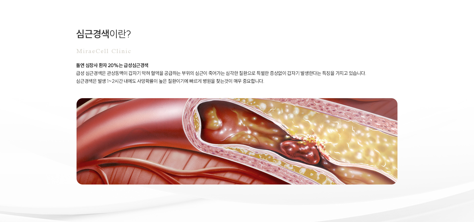 심근경색 예방 정의