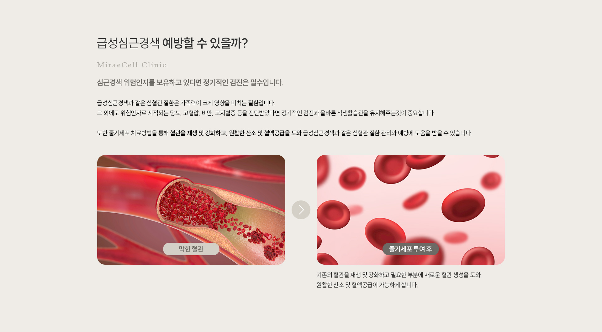 심근경색 예방 예방